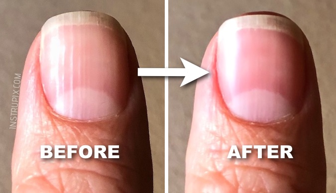 horizontal lines on the fingernails